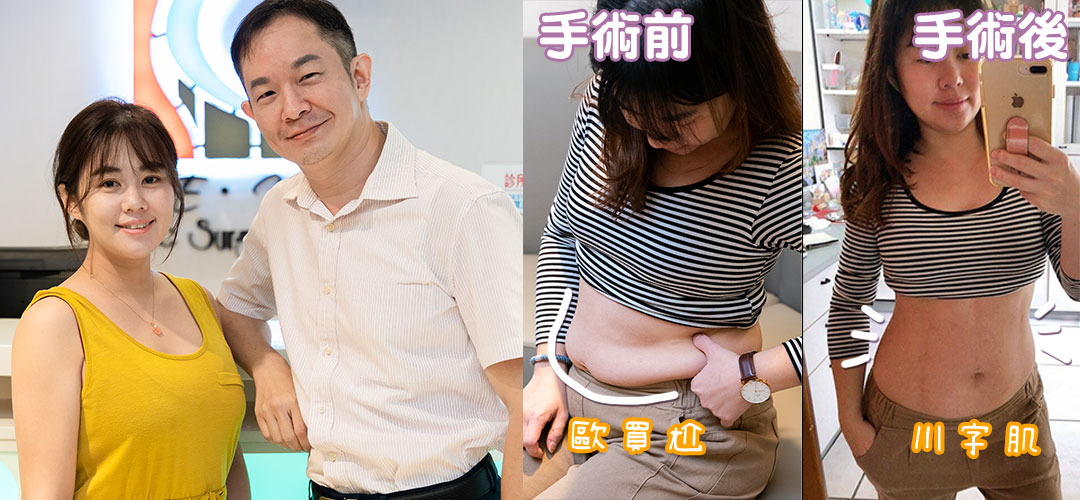 周爾康醫師威塑腹部抽脂腹腰環抽雕塑馬甲線+自體脂肪豐胸案例-14