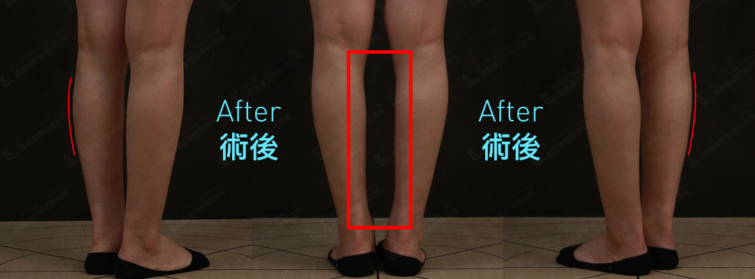 周爾康醫師小腿抽脂案例術前術後對比照-06
