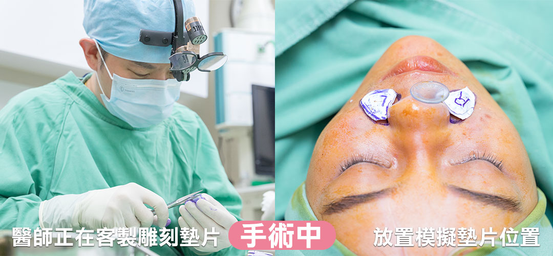 周爾康整形外科診所貴族手術/鼻溝槽手術改善法令紋手術中