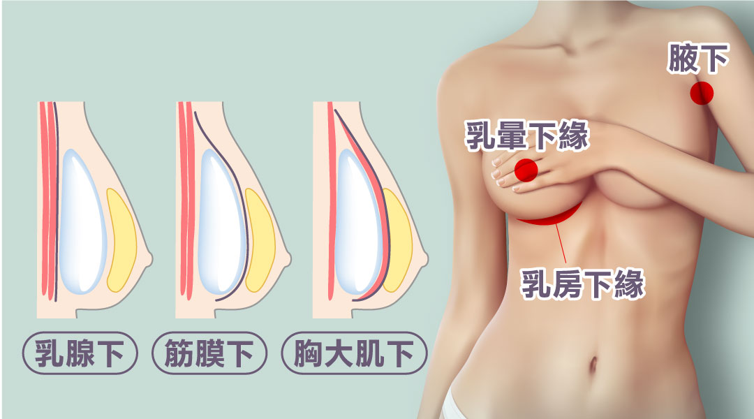 黃馨慧醫師複合式內視鏡台中隆乳手術切口/義乳位置