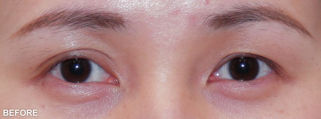 周爾康整形外科診所雙眼皮手術案例-01-1
