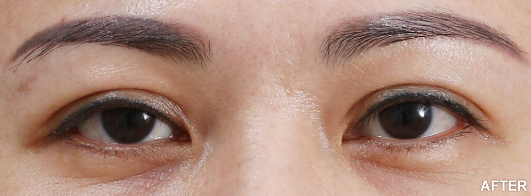周爾康整形外科診所雙眼皮手術案例-08-2