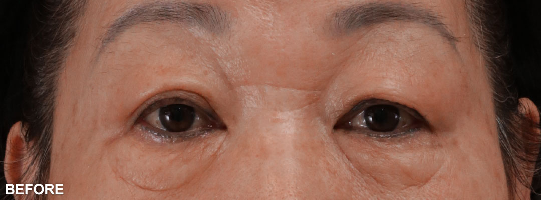 周爾康整形外科診所雙眼皮手術案例-10-1