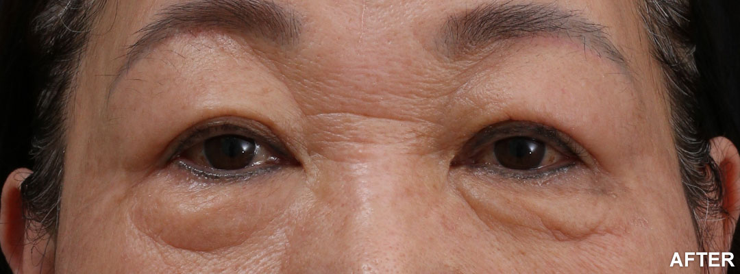 周爾康整形外科診所雙眼皮手術案例-10-2