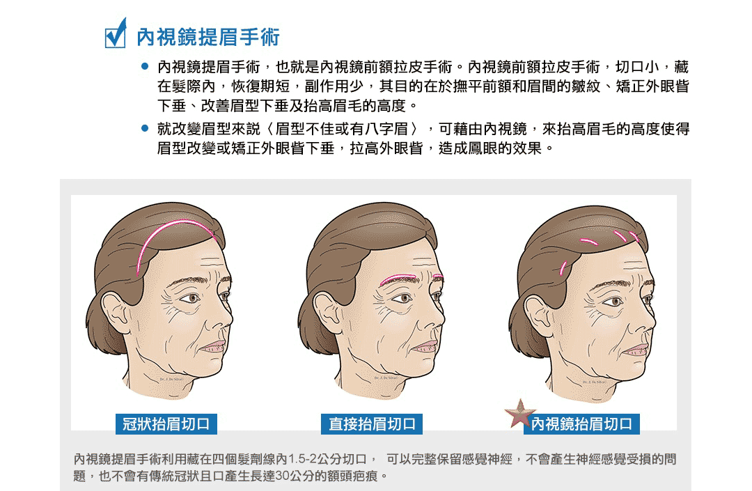 內視鏡提眉