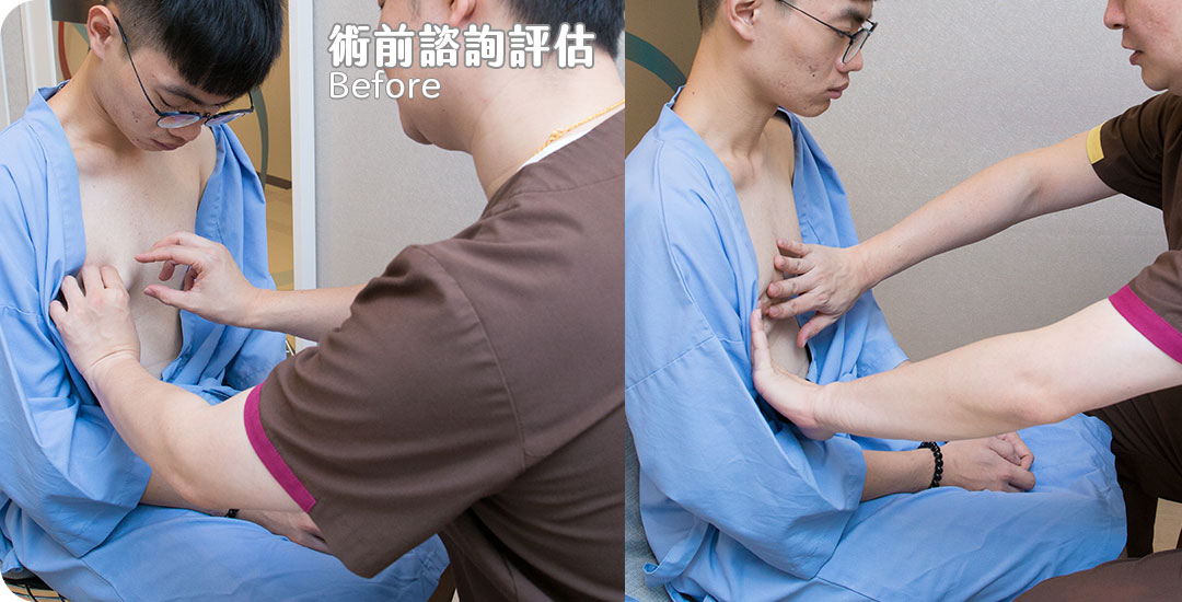 周爾康整形外科診所男性女乳手術案例-07
