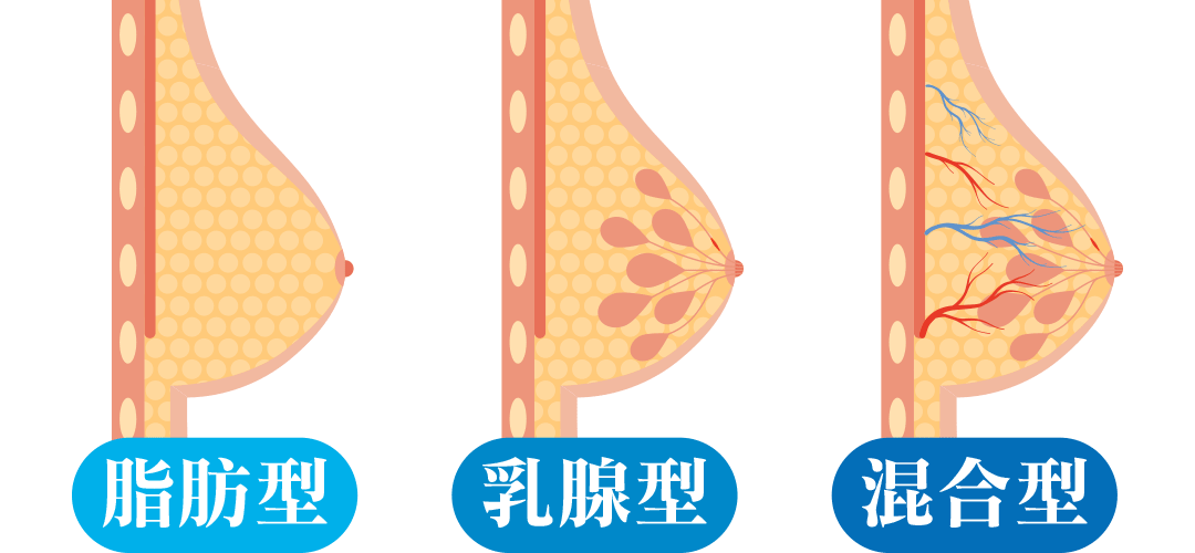 男性女乳症的3種類型