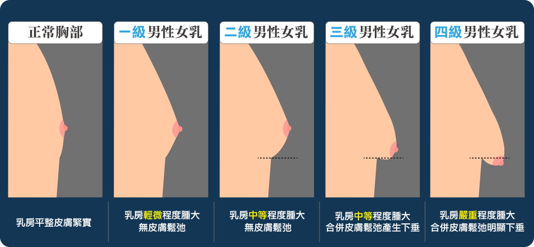 男性女乳症嚴重程度