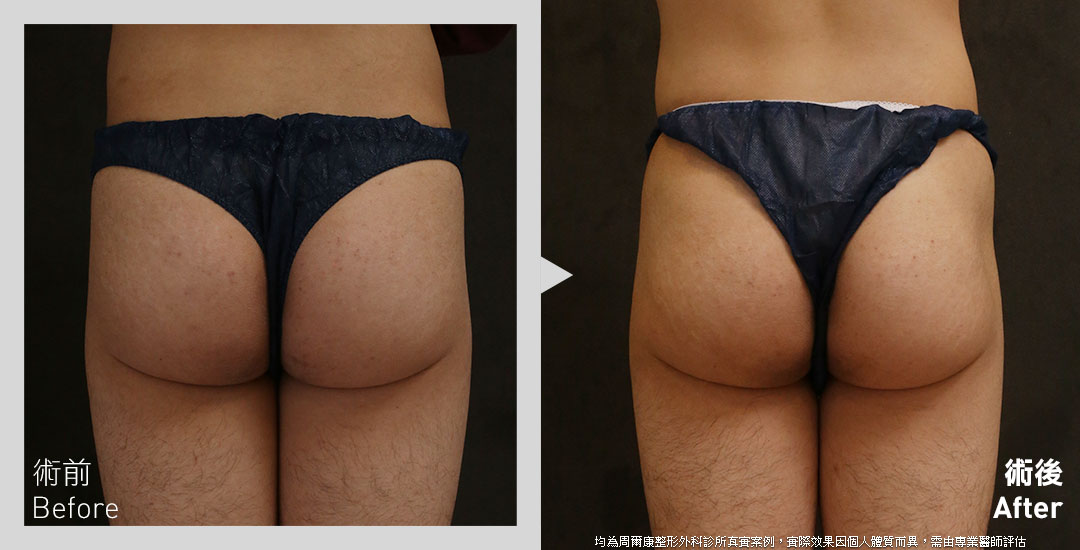 台中男性自體脂肪臀部抽脂案例-01