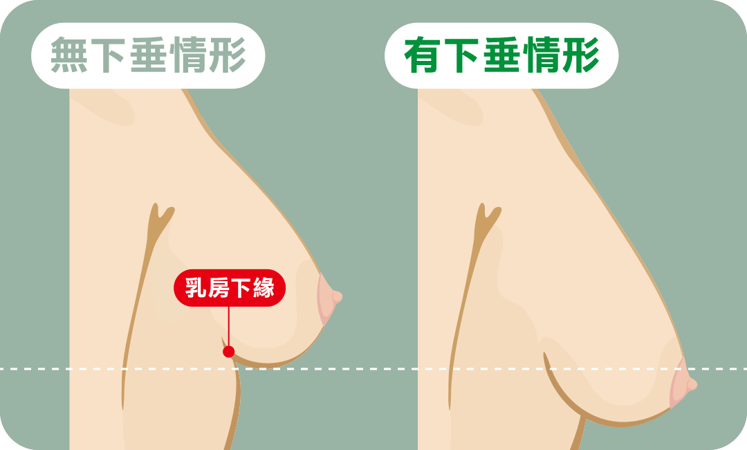 縮乳手術前該如何判斷胸部下垂