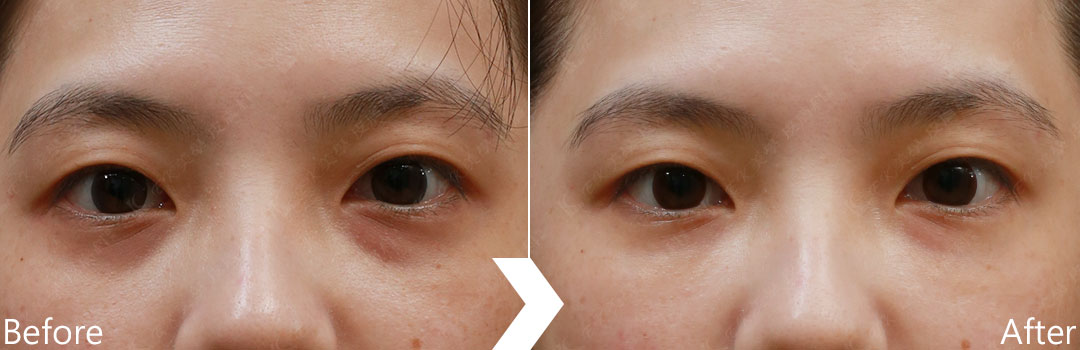 膠原蛋白植入劑案例-治療黑眼圈-01