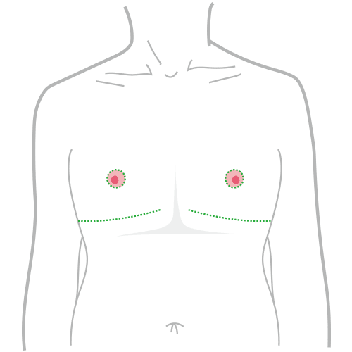平胸手術和縮胸手術比較，平胸手術推薦 