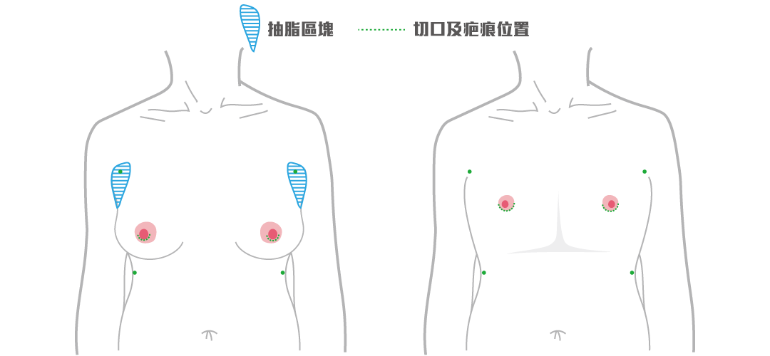 平胸手術方式：經乳暈微創平胸手術