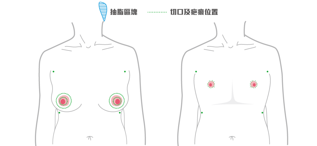平胸手術方式：兩階段式平胸手術