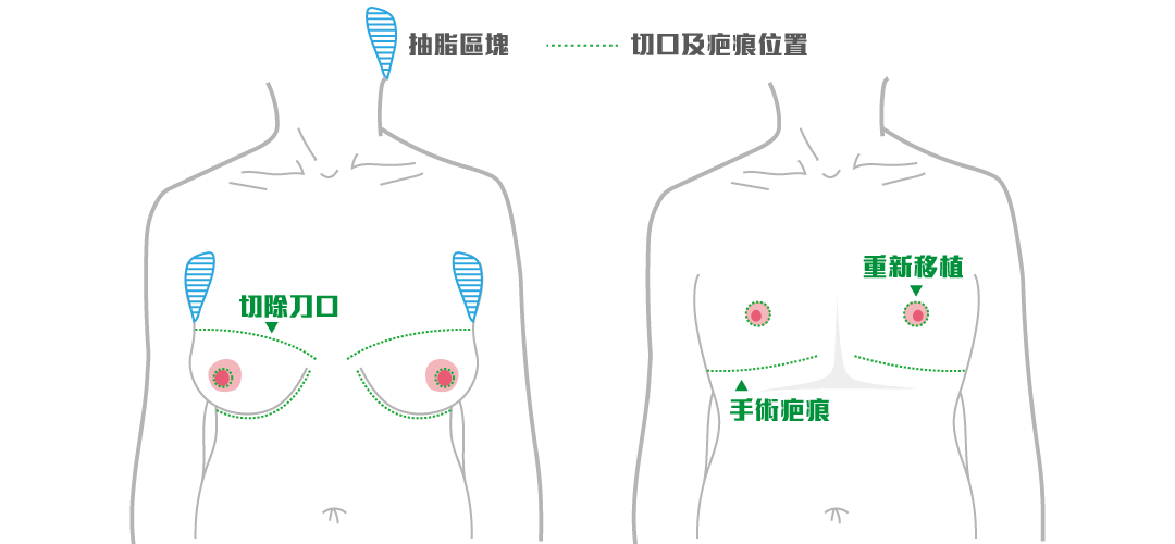 平胸手術方式：一字型平胸手術