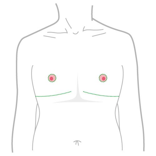 平胸 平胸手術Q&A全方位解析：不再讓胸部定義你的價值| 諾雅整形外科診所