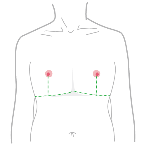 平胸手術方式：倒T型平胸手術