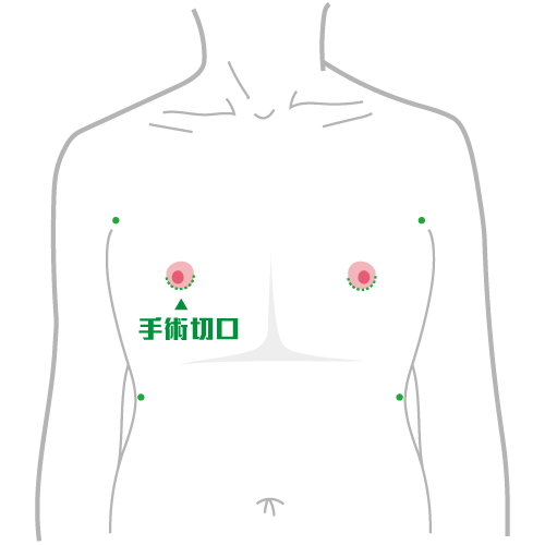平胸手術方式：乳暈微創平胸手術