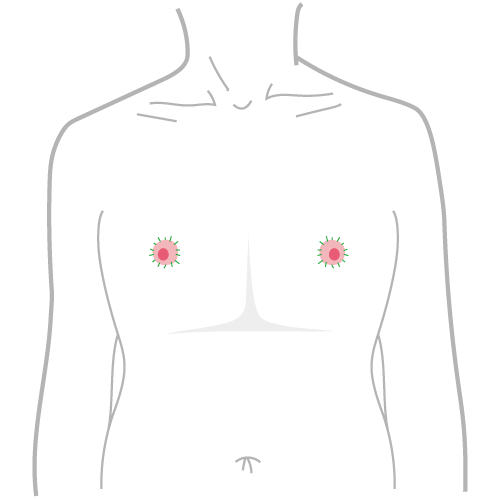 平胸手術方式：乳暈環切平胸手術