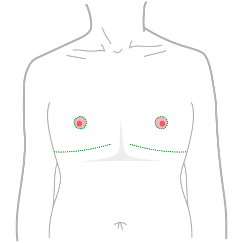 平胸手術方式：一字型平胸手術