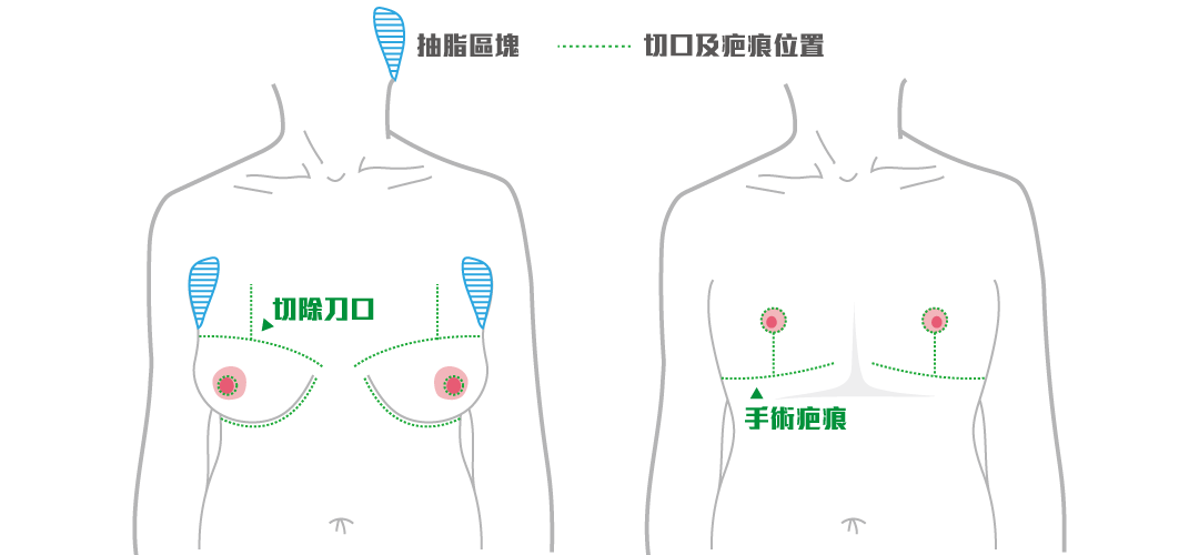 平胸手術方式：倒T型平胸手術