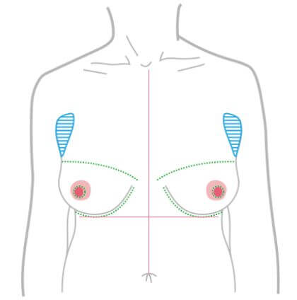平胸手術方式：一字形切口手術