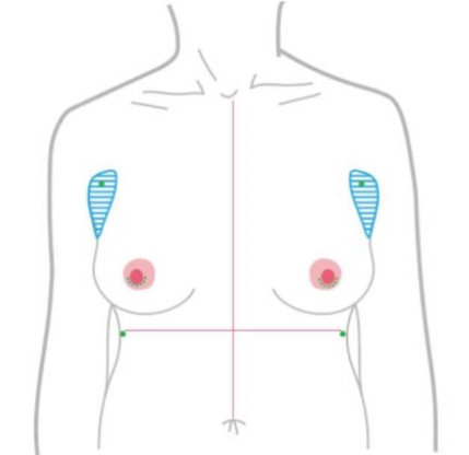 平胸手術方式：乳暈切口手術