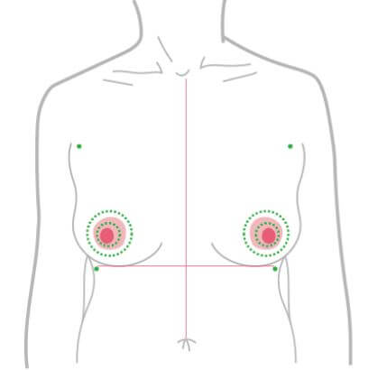 平胸手術方式：兩階段式平胸手術