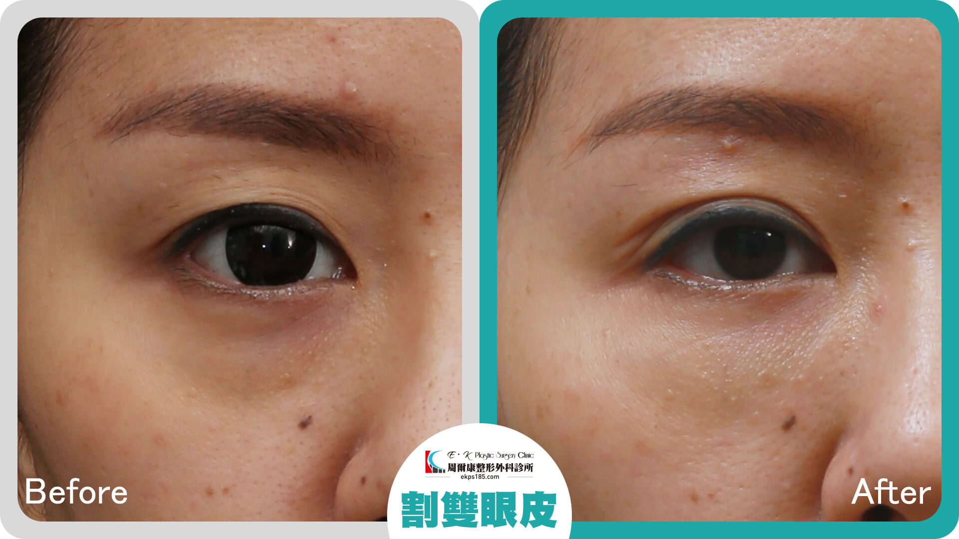 割雙眼皮_0831012_