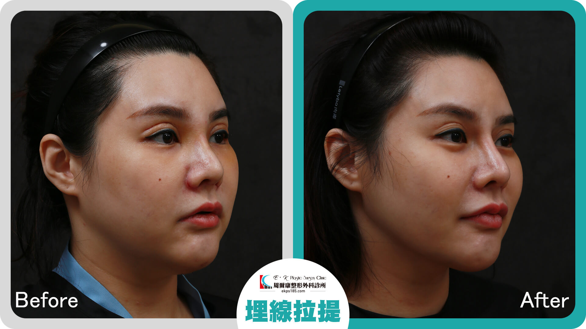 埋線拉提_0226021