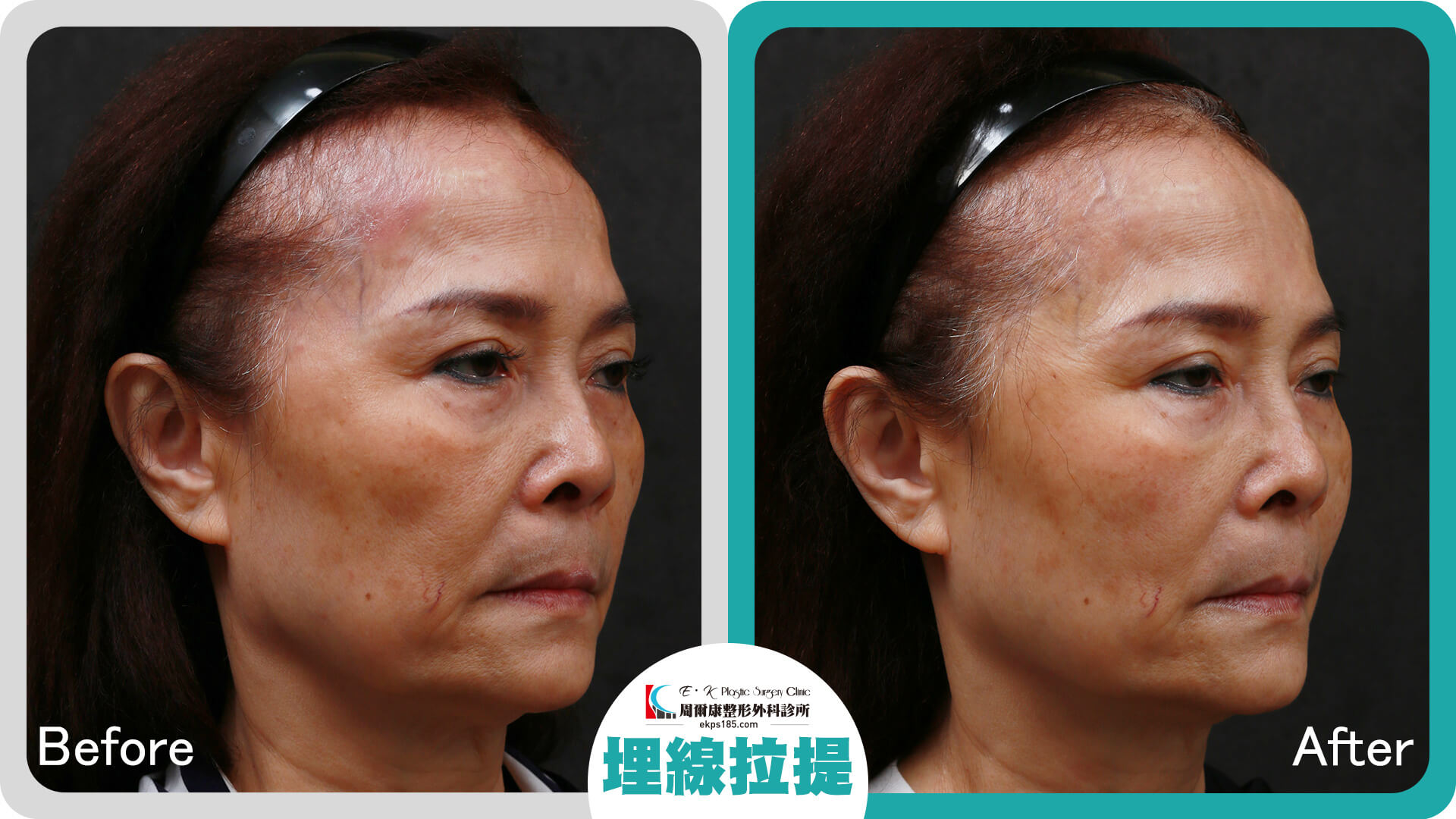 埋線拉提_0613023