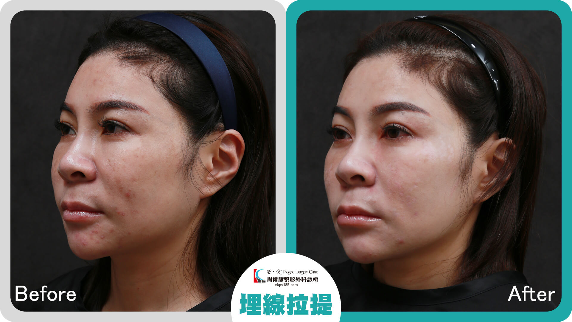 埋線拉提_0816008_