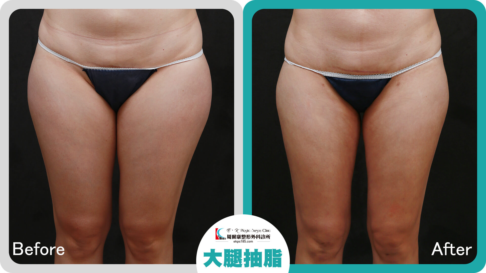 大腿抽脂_0907029