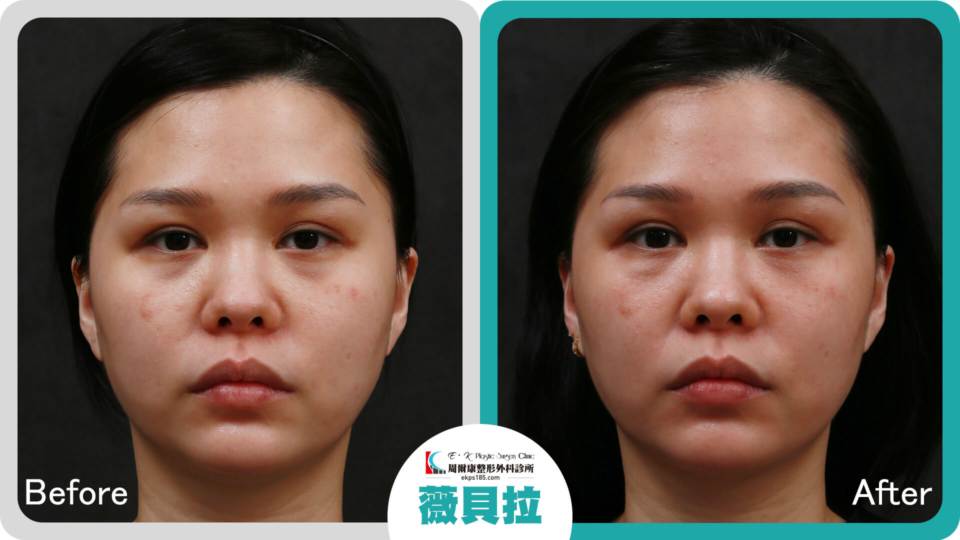 臉部凹陷流失困擾｜VIVABELLA薇貝拉｜03