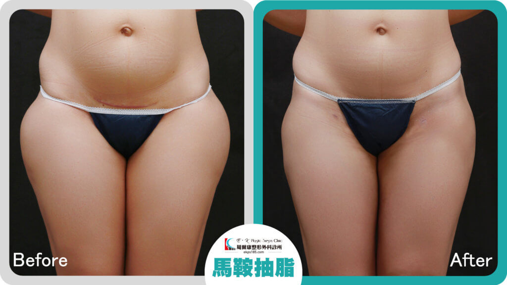 大腿抽脂＋鈦特離子夾術後效果