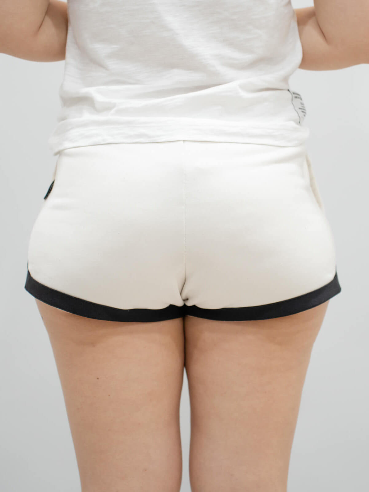 大腿抽脂＋鈦特離子夾術前02