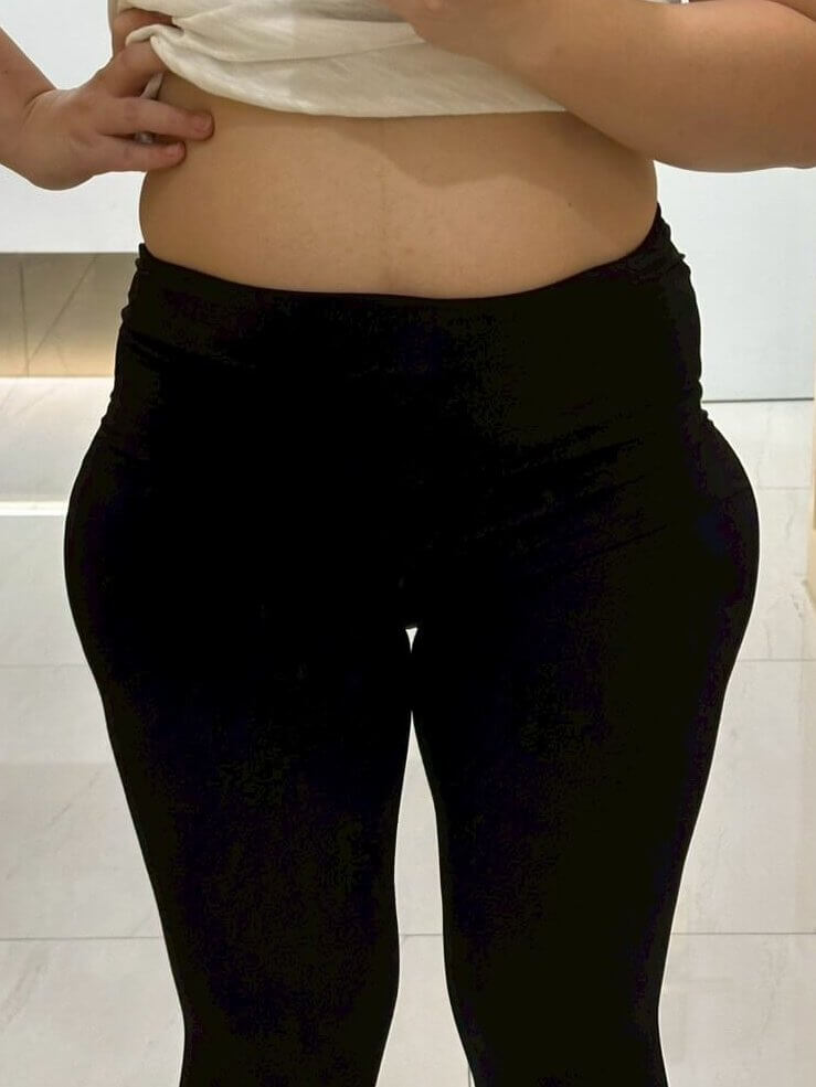 大腿抽脂＋鈦特離子夾術前01